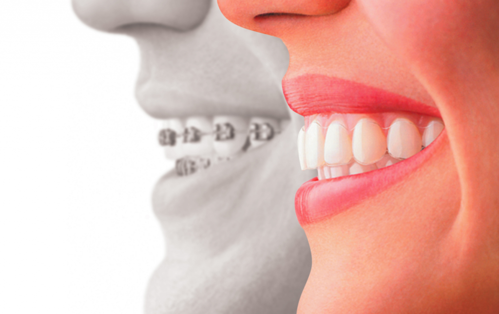 tipos ortodoncia