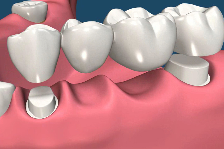 diferencias entre puente dental e implantes dentales - puente dental