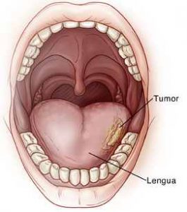 tumor bucal enfermedades dentales mas frecuentes