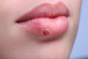 herpes enfermedades dentales mas frecuentes