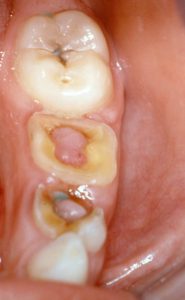 pulpitis enfermedades dentales mas frecuentes