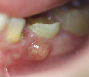 enfermedades dentales mas frecuentes quiste dental