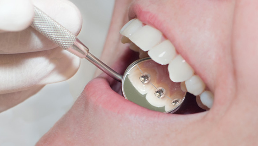 ortodoncia estetica lingual